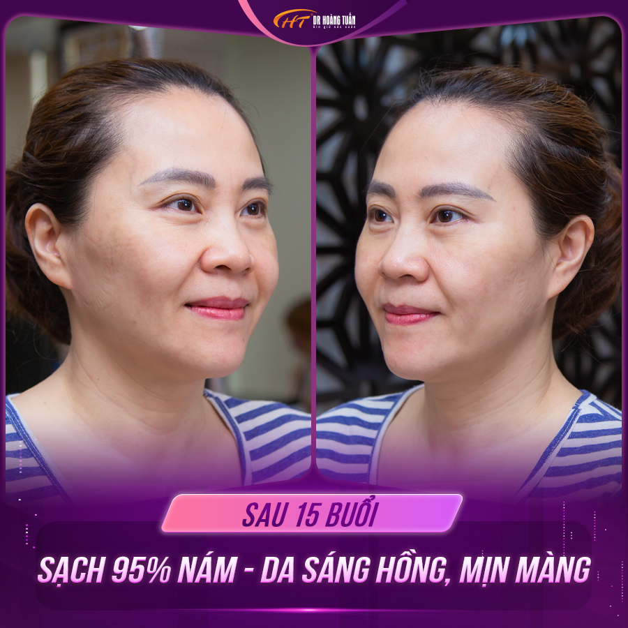 trị nám bằng laser có đau không
